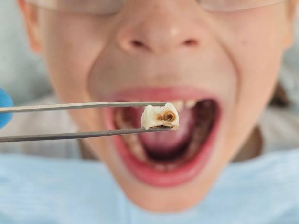 Best Emergency Treatment for Dental Infections or Abscesses in Russellville, AR