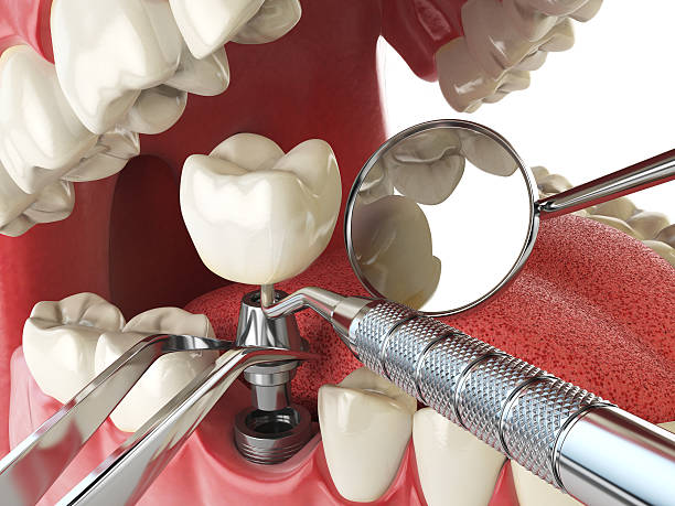 Best Emergency Root Canal Treatment in Russellville, AR